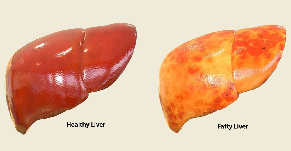 کبد چرب چیست